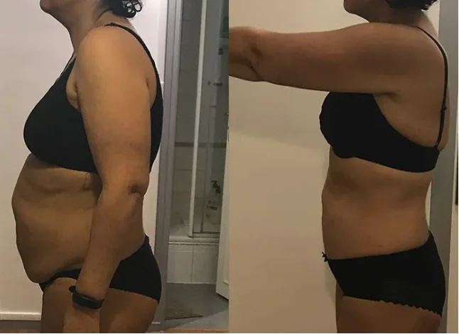 Avant / après de Valérie, 36 ans